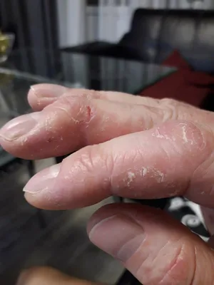 Фотография рук с проблемной кожей: скачать JPG, PNG, WebP