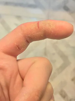 Фотография рук с проявлениями себорейного дерматита