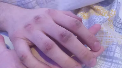 Фотография рук с проблемной кожей на фоне зеленой травы