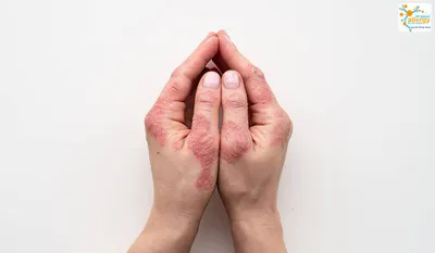 Изображение рук с микротрещинами после занятий в спортзале