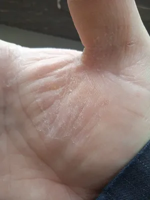 Фото рук с трескающейся кожей после длительного плавания в хлорированной воде