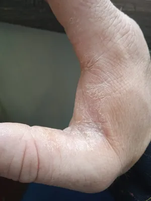 Фотография рук с проблемной кожей в зимнем лесу