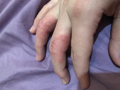 Изображение рук с нарушенным барьером кожи