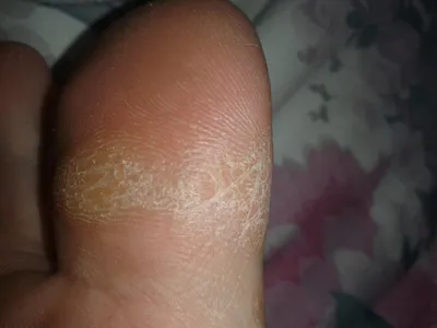 Фотография рук с сухой кожей
