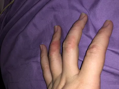 Фотография рук с крайне сухой кожей
