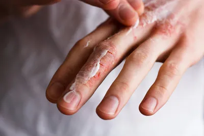 Фото рук: как избежать треска пальцев при контакте с химическими веществами