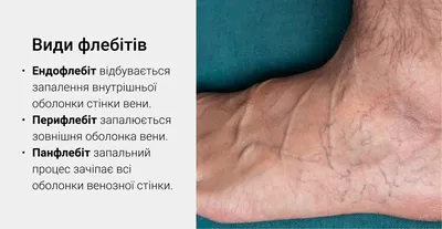 Изображения тромба на руке: узнайте о лечении