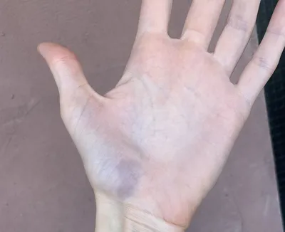 Фотки тромба на руке: макро съемка