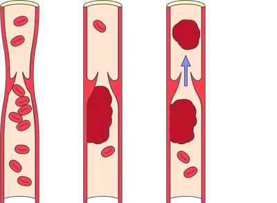 Тромб на руке: фото с описанием симптомов