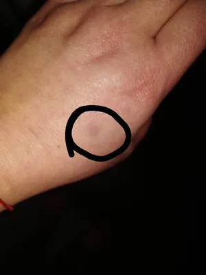 Фотографии тромба на руке: узнайте больше об этом заболевании