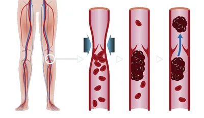 Картинка тромба в руке: какие факторы риска