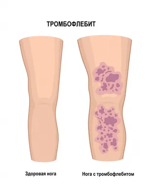 Фото тромбофлебита руки для диагностики заболевания