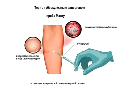 Дипломная работа на тему\"Туберкулёз у детей\" | Дипломная Инфекционные  болезни | Docsity