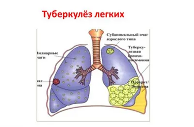 Милиарный туберкулез - причины появления, симптомы заболевания, диагностика  и способы лечения
