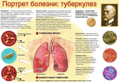 Туберкулез: что нужно знать, чтобы не заболеть