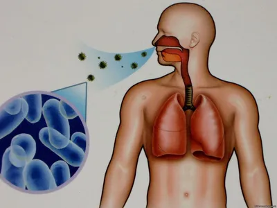 Туберкулез: симптомы, причины, формы, признаки