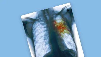 Центр общественного здоровья и медицинской профилактики » Что такое  туберкулез?