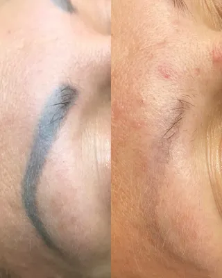 Фото: перед и после удаления татуажа бровей лазером