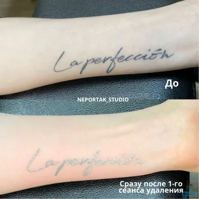 Фото сравнения до и после удаления татуажа бровей
