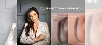 Результаты удаления татуажа бровей на фото