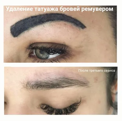 Картинки удаления татуажа ремувером с различными размерами
