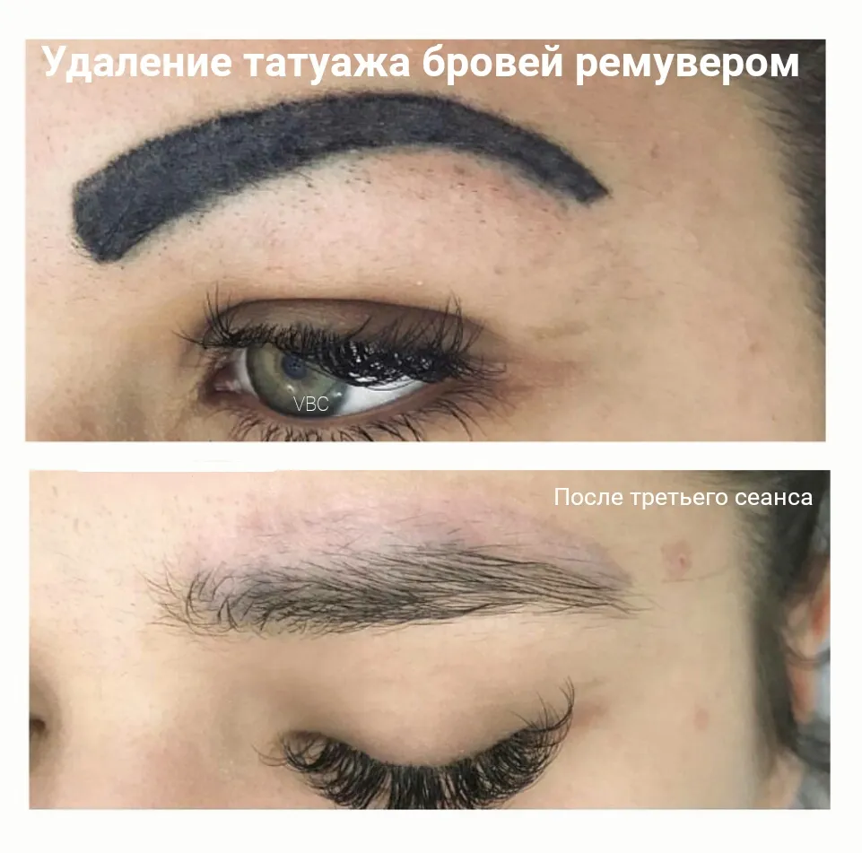 Картинки удаления татуажа ремувером с различными размерами Картинки удаления татуажа ремувером с различными размерами