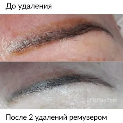 Фотографии удаления татуажа ремувером с комментариями