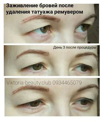 Фотографии удаления татуажа ремувером