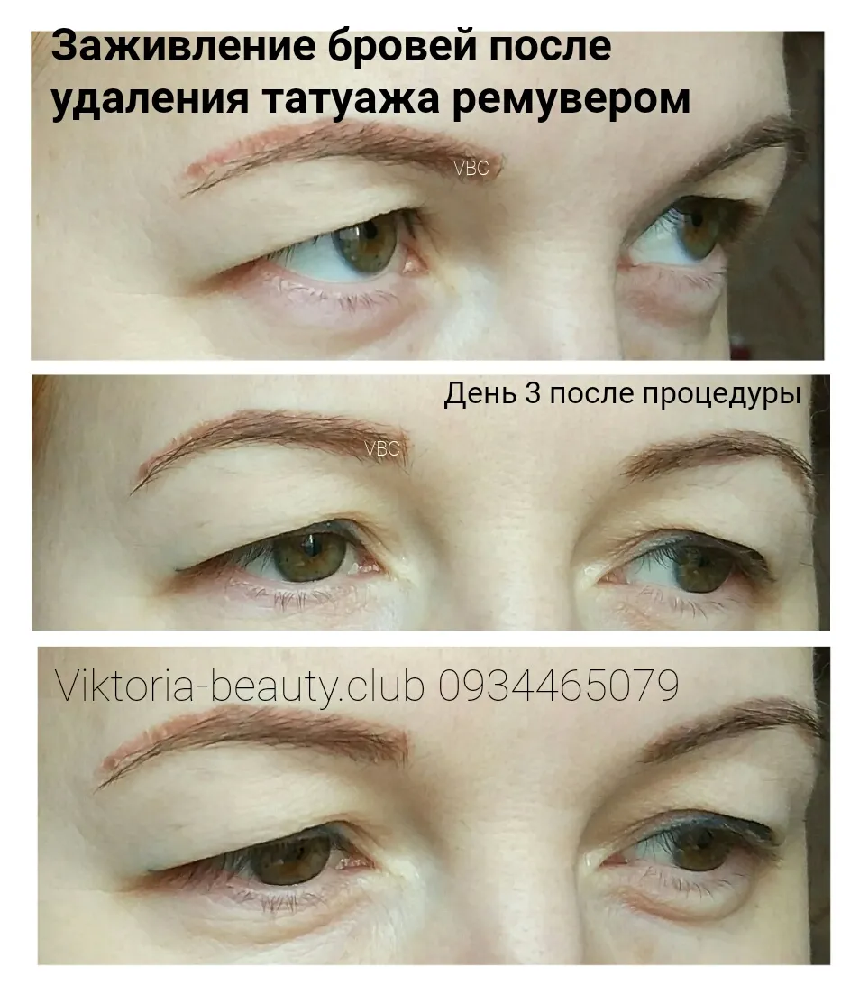 Фотографии удаления татуажа ремувером Фотографии удаления татуажа ремувером