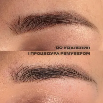 Фотографии удаления татуажа ремувером с отзывами