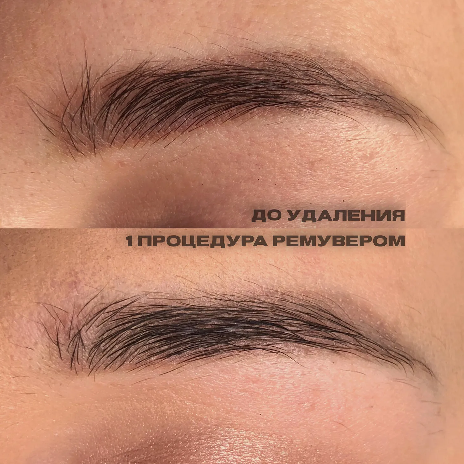 Фотографии удаления татуажа ремувером с отзывами Фотографии удаления татуажа ремувером с отзывами