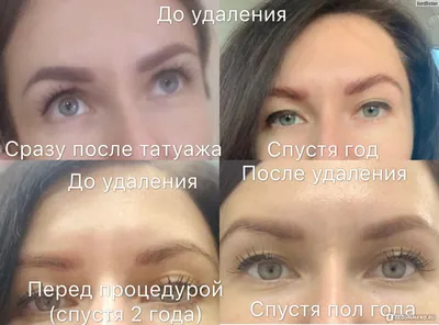 Фотографии удаления татуажа ремувером для чувствительной кожи
