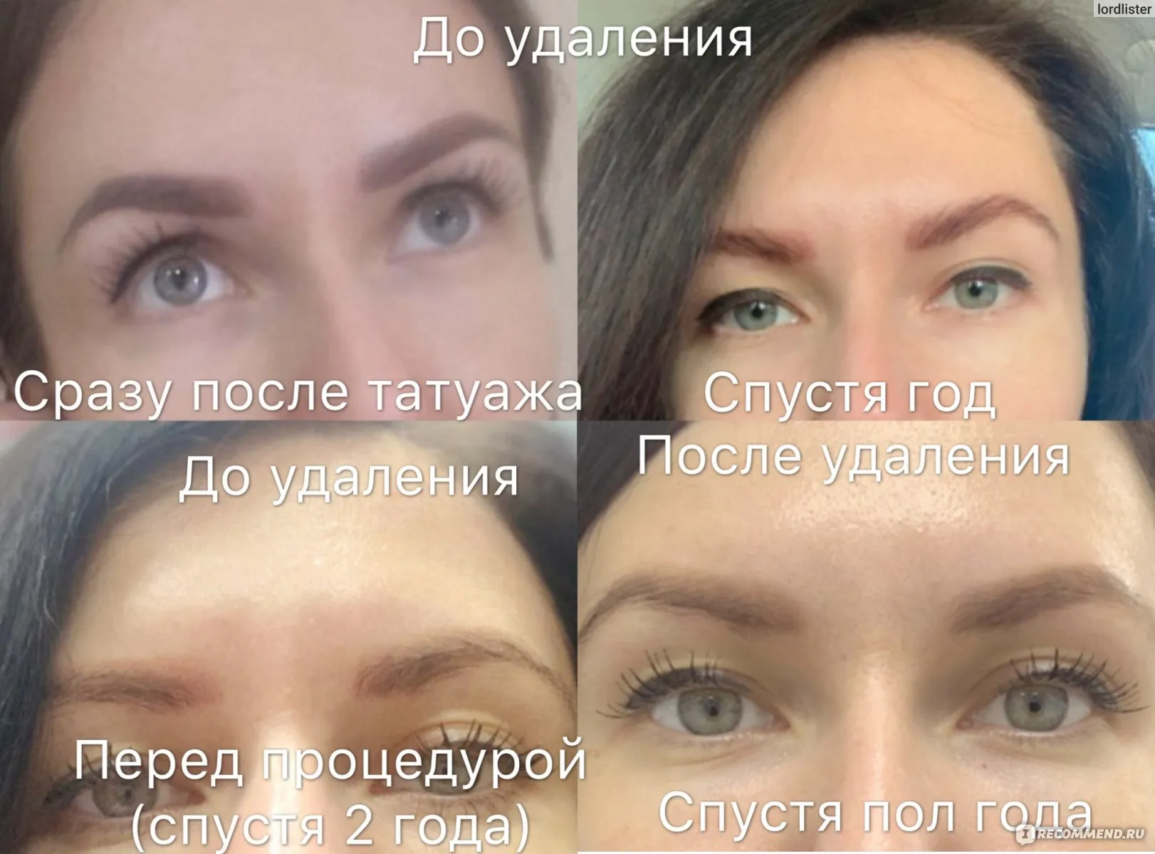 Фотографии удаления татуажа ремувером для чувствительной кожи Фотографии удаления татуажа ремувером для чувствительной кожи