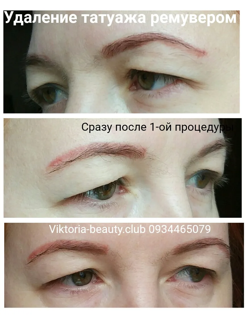 Фото удаления татуажа ремувером в формате JPG Фото удаления татуажа ремувером в формате JPG