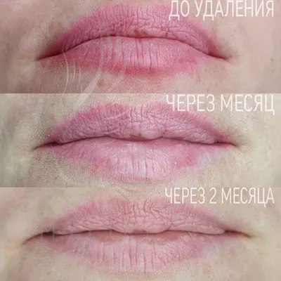 Картинки удаления татуажа ремувером для начинающих мастеров перманентного макияжа.