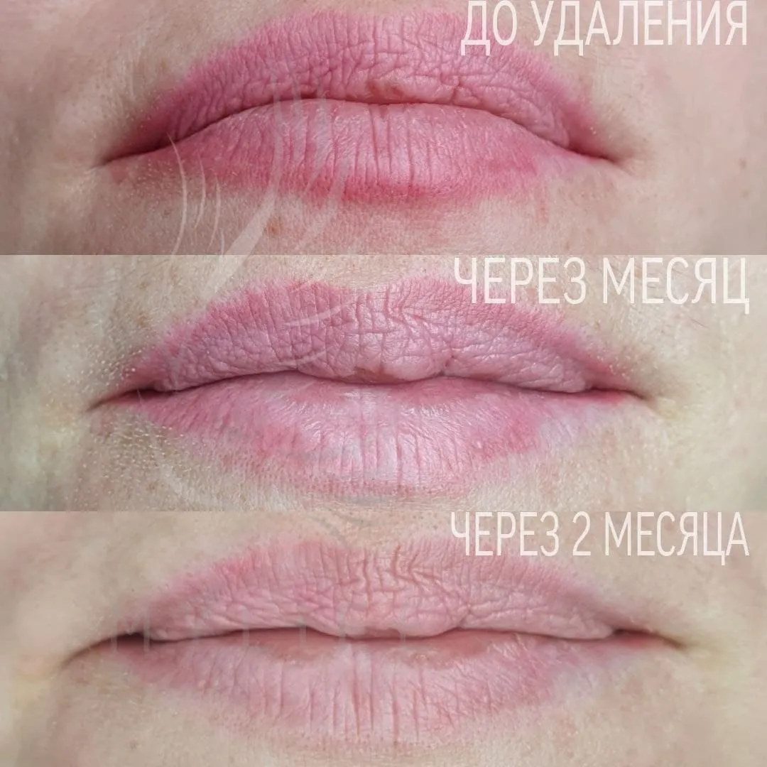 Картинки удаления татуажа ремувером для начинающих мастеров перманентного макияжа. Картинки удаления татуажа ремувером для начинающих мастеров перманентного макияжа.