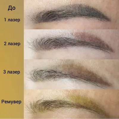 Фото: удаление татуажа ремувером на разных частях тела