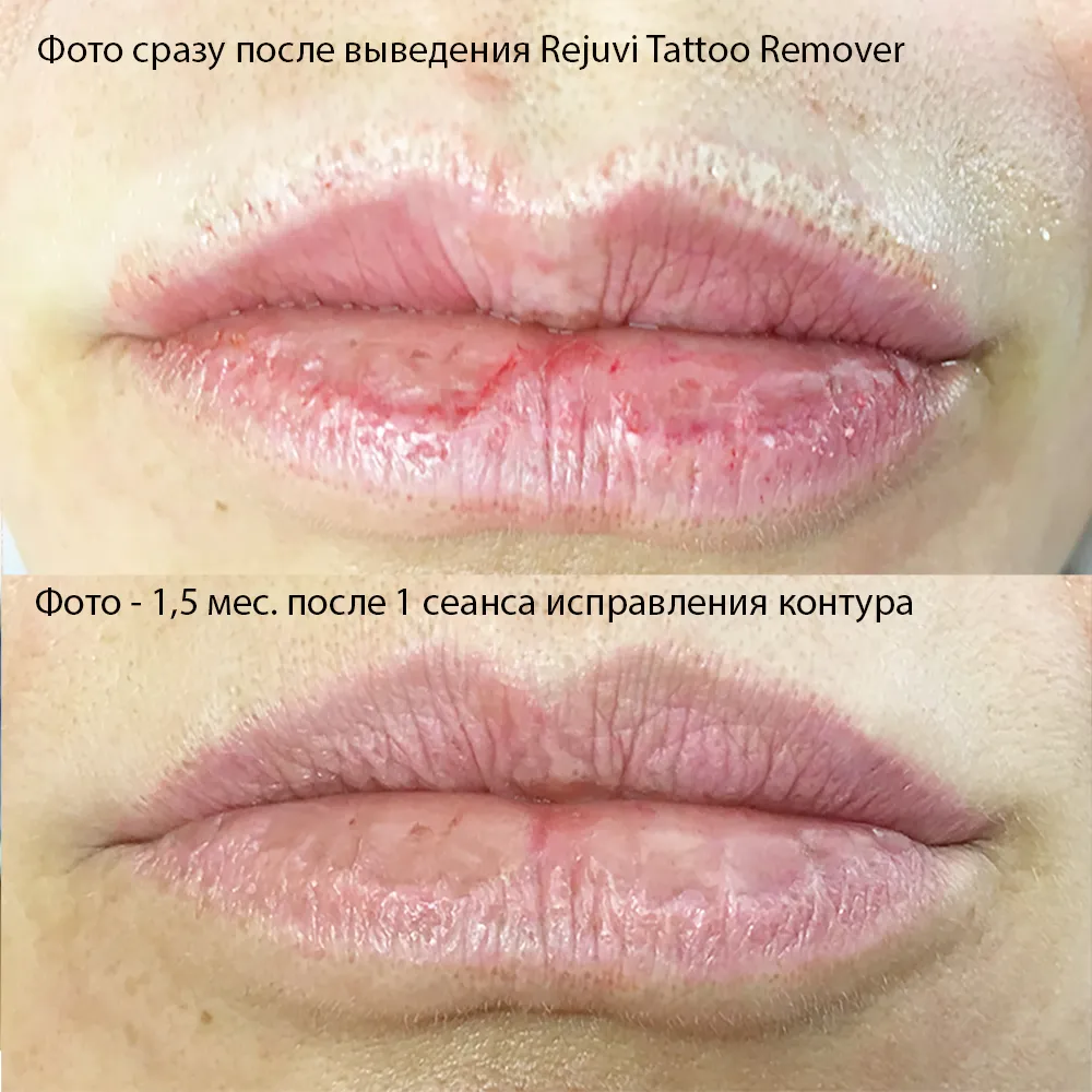 Изображение: удаление татуажа ремувером на руке Изображение: удаление татуажа ремувером на руке