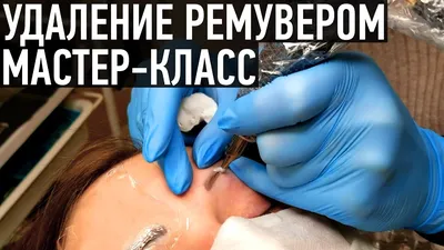 Картинка: удаление татуажа ремувером на руке в большом размере