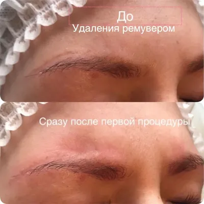 Изображения процесса удаления татуажа с помощью ремувера