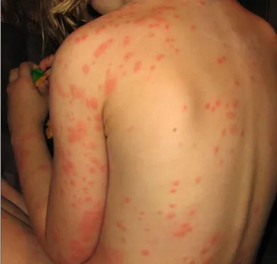 Аллергия или укус клопа? Неправильные диагнозы врачей | Эко СЭС | Дзен