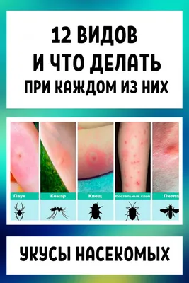 Как различить укусы насекомых, чем они опасны, как оказать помощь?