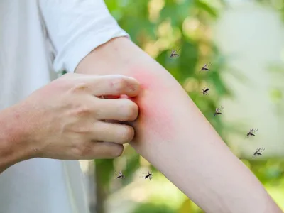 Аллергия на укусы насекомых: какие симптомы и что делать