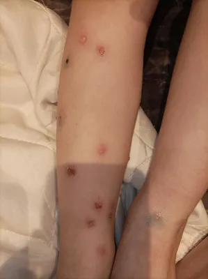 Трое жителей Ростовской области заразились опасными паразитами от укусов  комаров