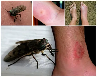 Аллергия на укусы насекомых (отек, зуд) – симптомы, проявление и лечение