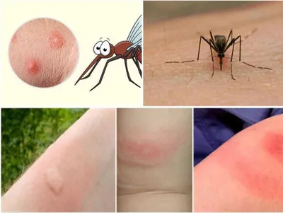 Что меня укусило? Как выглядят укусы семи разных видов насекомых