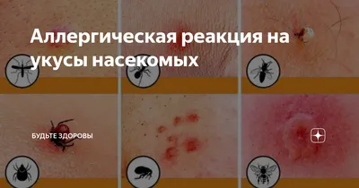 Как избавиться от укусов комаров: симптомы, лечение - FitoBlog
