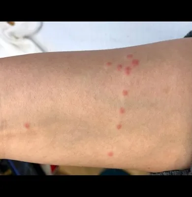 Аллергическая реакция на укусы насекомых | Живите без боли | Дзен
