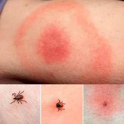 Что делать, если вас укусило насекомое | doc.ua