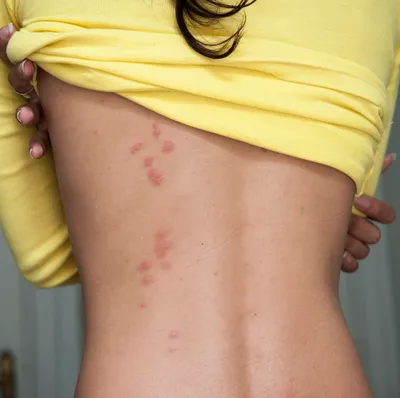 Аллергия на укус комара: чем лечить, симптомы, фото | РБК Life